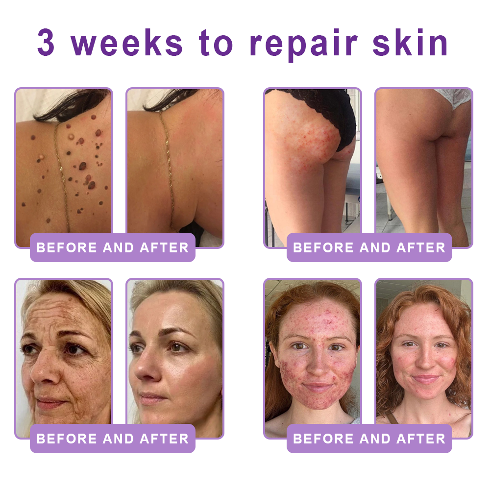 HISKIN® PDRN Multi-Peptide Massaging Body Roller Cream- Anti-aging, Hydrating, Skin Firming & Lifting, Skin Repair, Even Tone, Acne and Dark Spot Treatment, Wart and Mole Removal, and Psoriasis Relief.