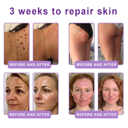 HISKIN® PDRN Multi-Peptide Massaging Body Roller Cream- Anti-aging, Hydrating, Skin Firming & Lifting, Skin Repair, Even Tone, Acne and Dark Spot Treatment, Wart and Mole Removal, and Psoriasis Relief.