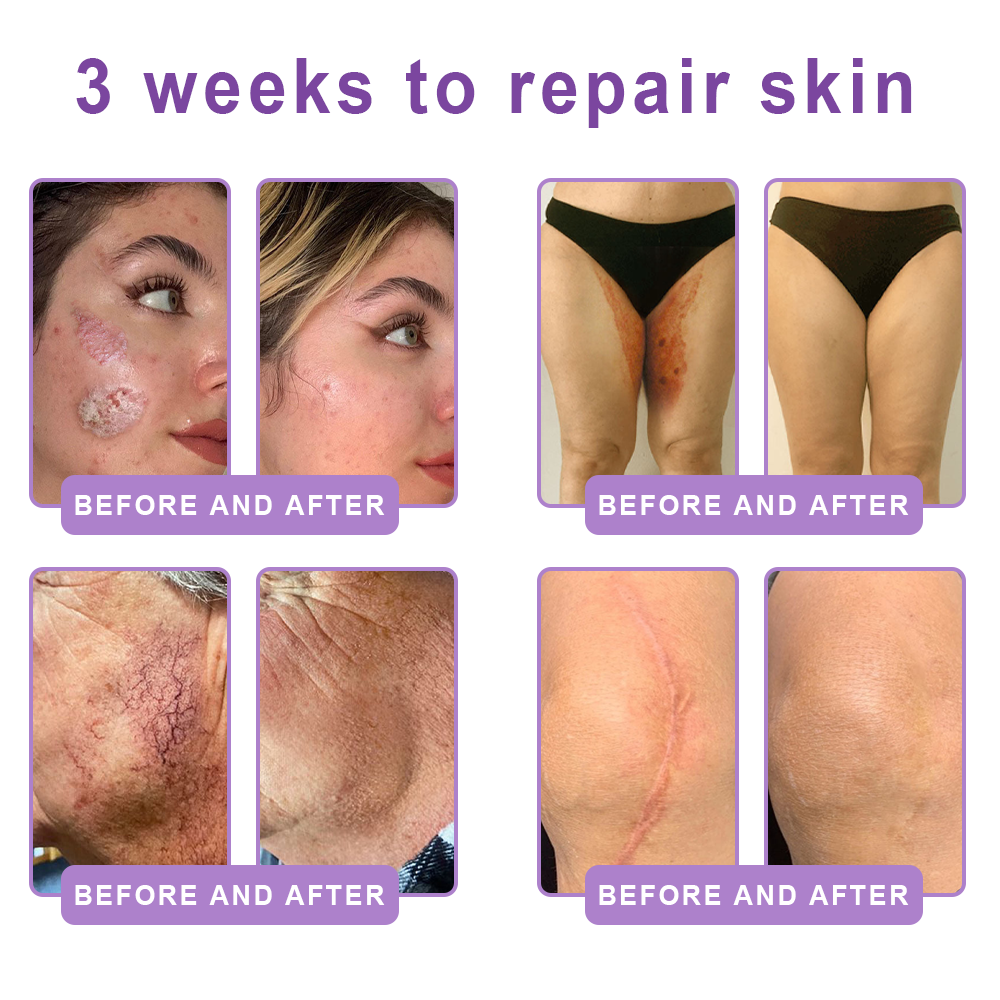 HISKIN® PDRN Multi-Peptide Massaging Body Roller Cream- Anti-aging, Hydrating, Skin Firming & Lifting, Skin Repair, Even Tone, Acne and Dark Spot Treatment, Wart and Mole Removal, and Psoriasis Relief.