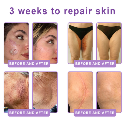 HISKIN® PDRN Multi-Peptide Massaging Body Roller Cream- Anti-aging, Hydrating, Skin Firming & Lifting, Skin Repair, Even Tone, Acne and Dark Spot Treatment, Wart and Mole Removal, and Psoriasis Relief.