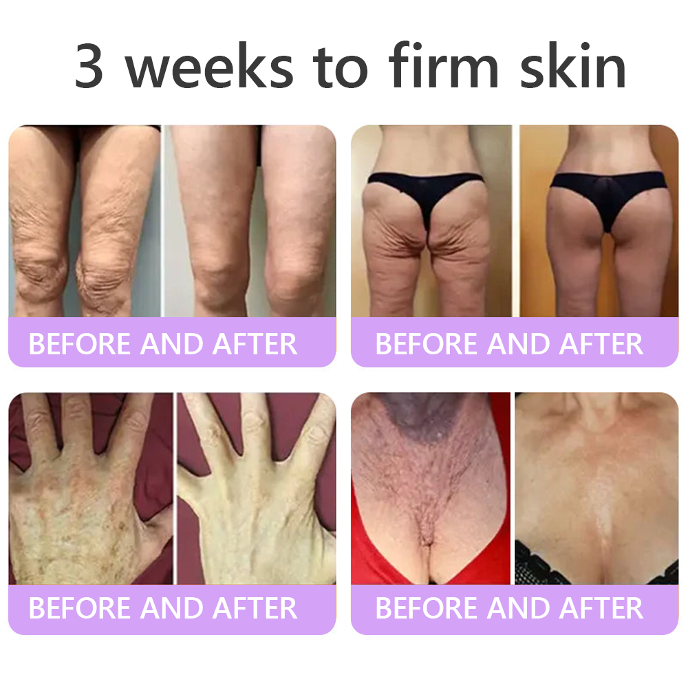 HISKIN® PDRN Multi-Peptide Massaging Body Roller Cream- Anti-aging, Hydrating, Skin Firming & Lifting, Skin Repair, Even Tone, Acne and Dark Spot Treatment, Wart and Mole Removal, and Psoriasis Relief.