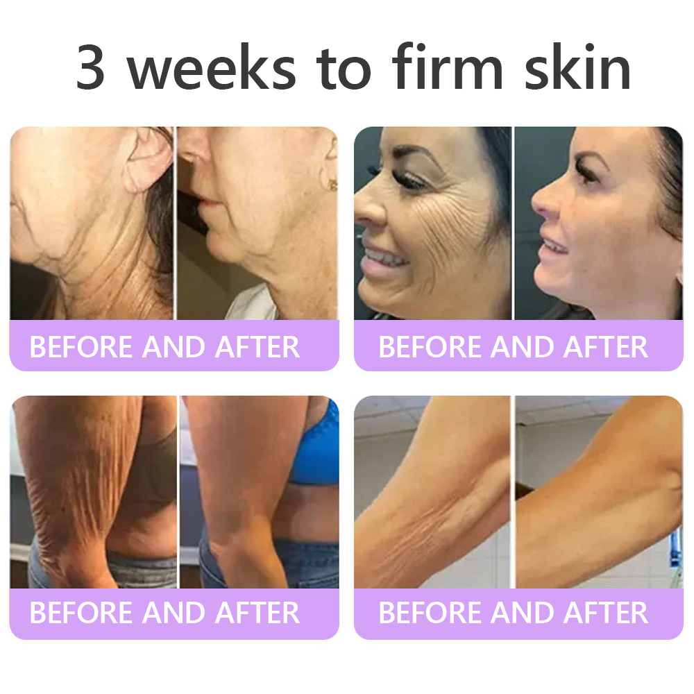HISKIN® PDRN Multi-Peptide Massaging Body Roller Cream- Anti-aging, Hydrating, Skin Firming & Lifting, Skin Repair, Even Tone, Acne and Dark Spot Treatment, Wart and Mole Removal, and Psoriasis Relief.