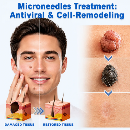 ✨Hiskin ® 2-in-1 Microneedle & Hydrocolloid Patch🍀 | Removes raised moles, acne, flat warts, and skin tags | Helps improve wrinkles, scars, and blemishes | Invisible patches for face and body