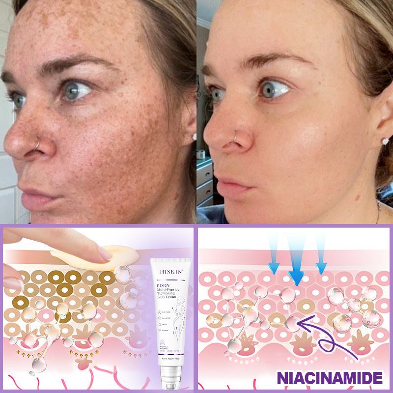 HISKIN® PDRN Multi-Peptide Massaging Body Roller Cream- Anti-aging, Hydrating, Skin Firming & Lifting, Skin Repair, Even Tone, Acne and Dark Spot Treatment, Wart and Mole Removal, and Psoriasis Relief.