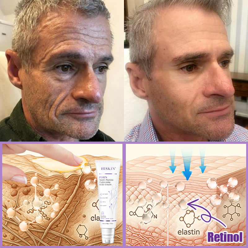 HISKIN® PDRN Multi-Peptide Massaging Body Roller Cream- Anti-aging, Hydrating, Skin Firming & Lifting, Skin Repair, Even Tone, Acne and Dark Spot Treatment, Wart and Mole Removal, and Psoriasis Relief.