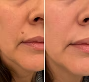 ✨Hiskin® Restore flawless bump-free skin effortlessly. Miss out now, and you won't have another chance until next year.