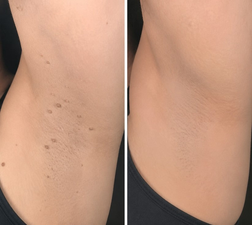 ✨Hiskin® Restore flawless bump-free skin effortlessly. Miss out now, and you won't have another chance until next year.