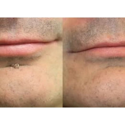 ✨Hiskin® Restore flawless bump-free skin effortlessly. Miss out now, and you won't have another chance until next year.