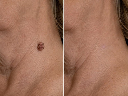 ✨Hiskin® Restore flawless bump-free skin effortlessly. Miss out now, and you won't have another chance until next year.
