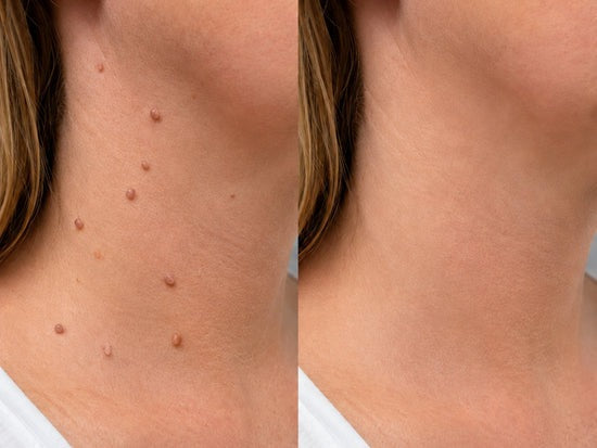 ✨Hiskin® Restore flawless bump-free skin effortlessly. Miss out now, and you won't have another chance until next year.