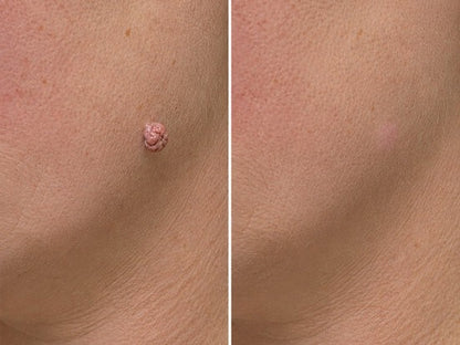 ✨Hiskin® Restore flawless bump-free skin effortlessly. Miss out now, and you won't have another chance until next year.