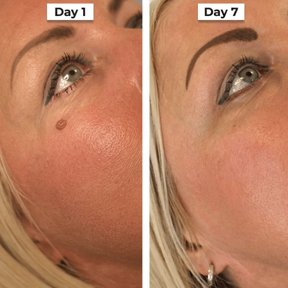 HISKIN® 3-7 Day Skin Tag Ligation Remover