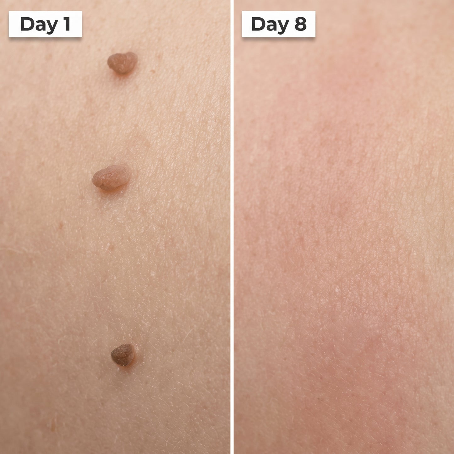 HISKIN® 3-7 Day Skin Tag Ligation Remover