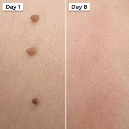 HISKIN® 3-7 Day Skin Tag Ligation Remover