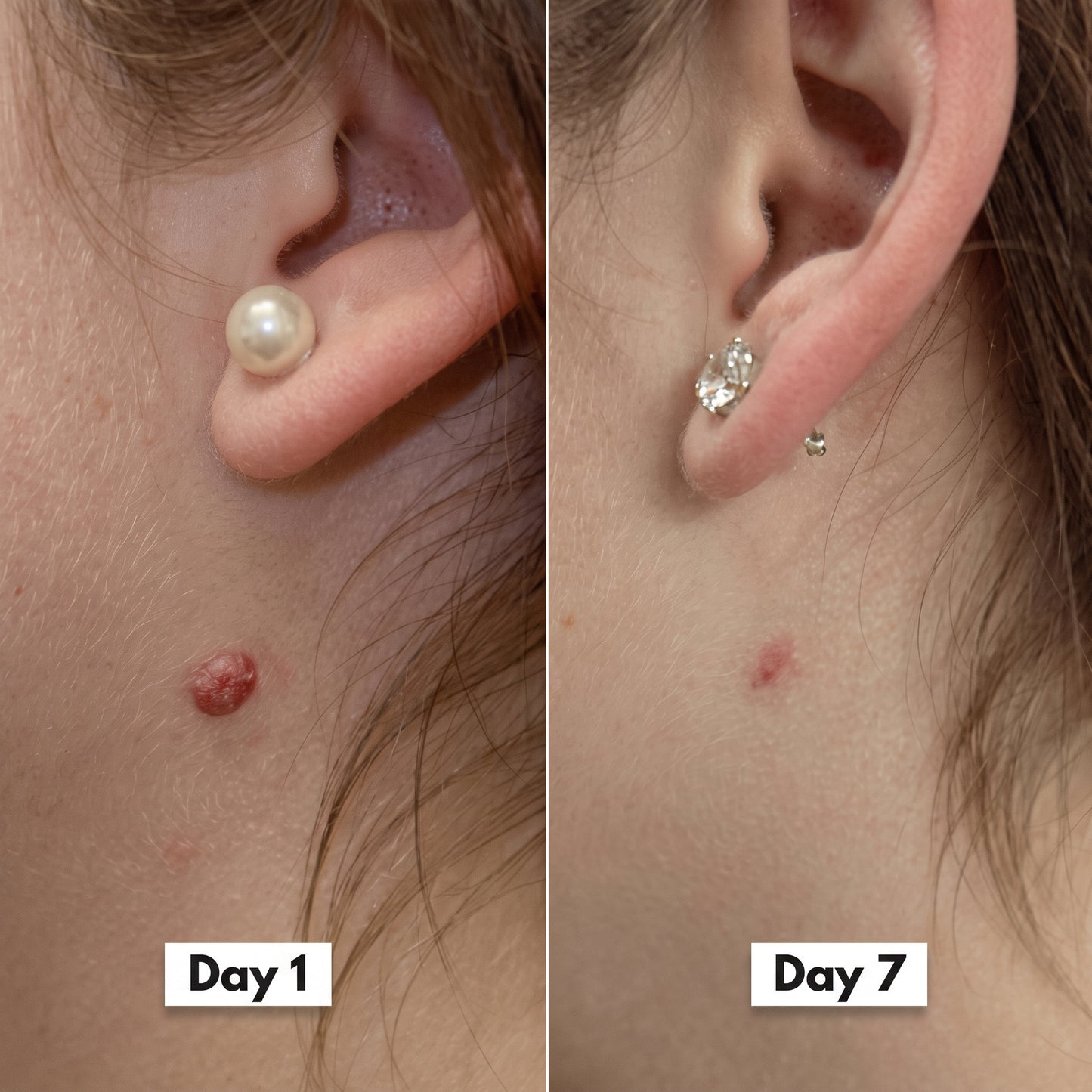 HISKIN® 3-7 Day Skin Tag Ligation Remover