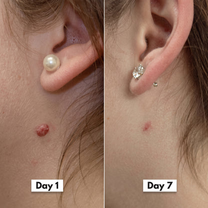HISKIN® 3-7 Day Skin Tag Ligation Remover