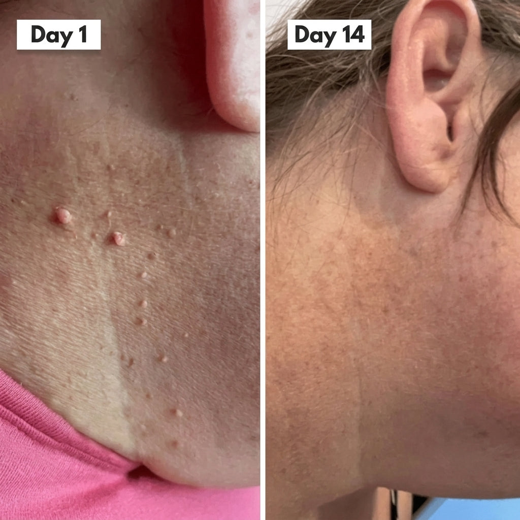 HISKIN® 3-7 Day Skin Tag Ligation Remover