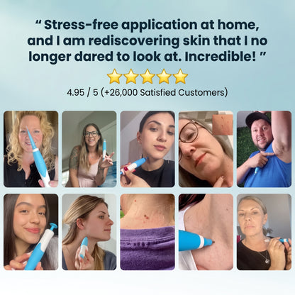HISKIN® 3-7 Day Skin Tag Ligation Remover